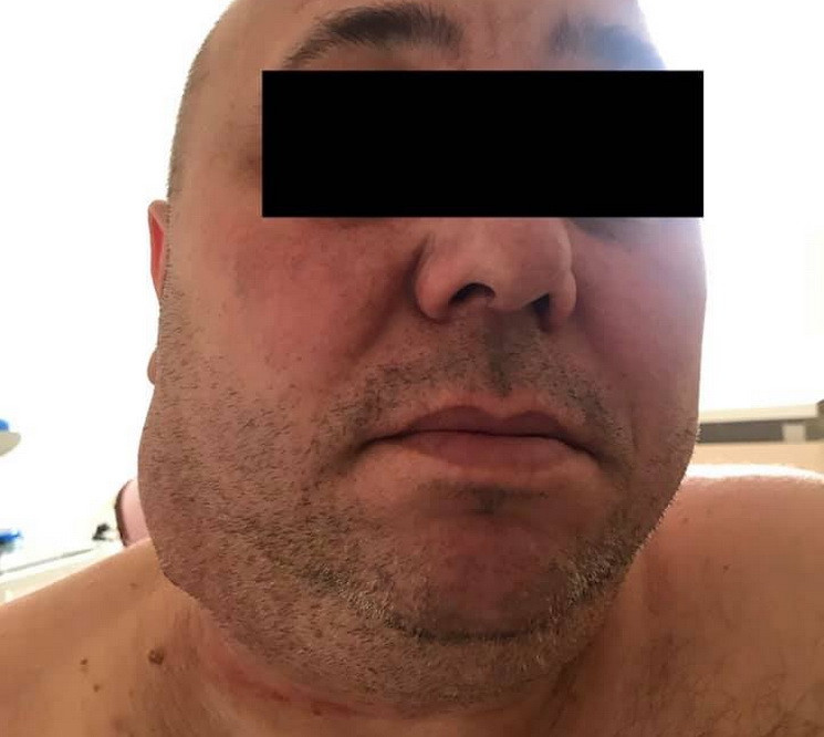 У лікарні Дніпра провели надскладну операцію з видалення пухлини