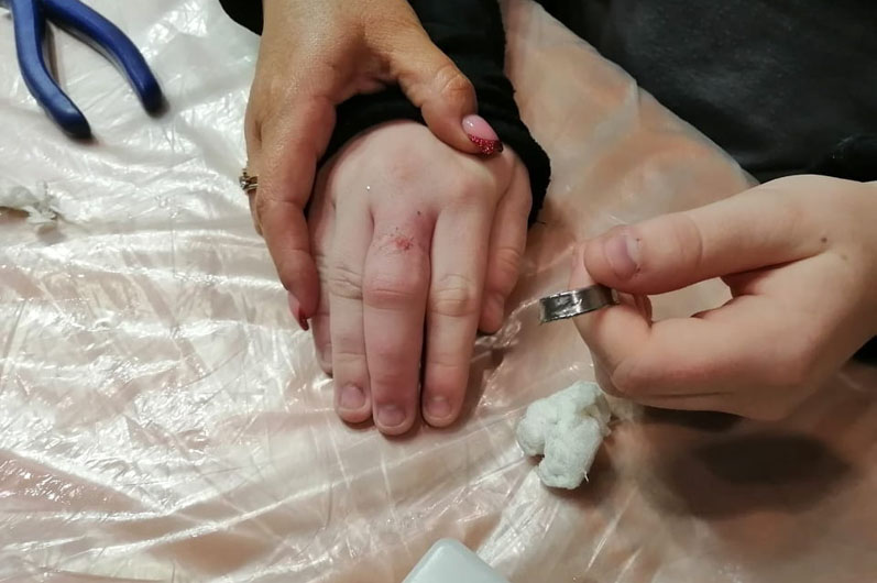 У Павлограді рятувальники визволили палець дівчинки з металевого кільця